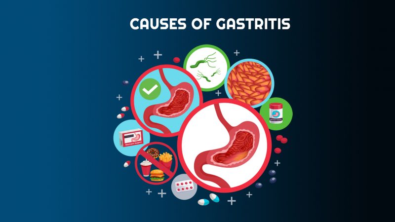 Gastritis – মূল কারণ, প্রতিকার ও আয়ুর্বেদিক ঘরোয়া চিকিৎসা