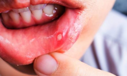 MOUTH ULCERS (মুখের আলসার)’র কারণ, লক্ষণ ও আপদকালীন স্ব-সহায়িকা!