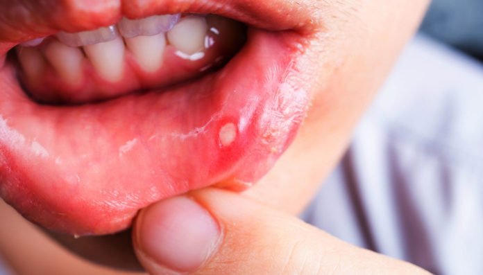 MOUTH ULCERS (মুখের আলসার)’র কারণ, লক্ষণ ও আপদকালীন স্ব-সহায়িকা!