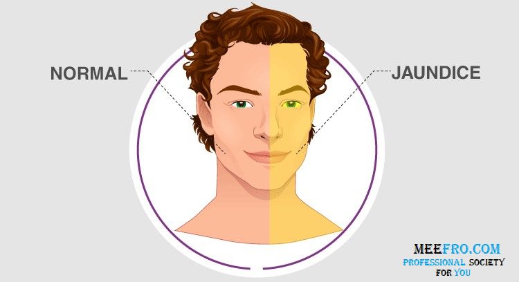 জন্ডিস (Jaundice) বা কামলা কারণ, আপদকালিন চিকিৎসা ও পথ্যাপথ্য!