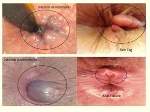 Piles-haemorrhoids