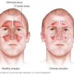 Sinusitis এর আয়ুর্বেদিক স্ব-সহায়ক নির্দেশিকা!