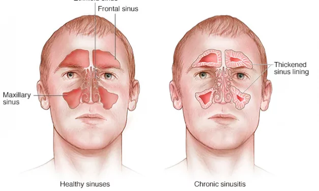 Sinusitis এর আয়ুর্বেদিক স্ব-সহায়ক নির্দেশিকা!