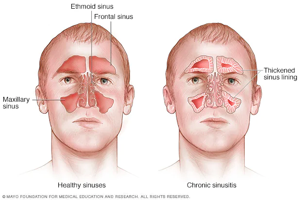 Sinusitis এর আয়ুর্বেদিক স্ব-সহায়ক নির্দেশিকা!